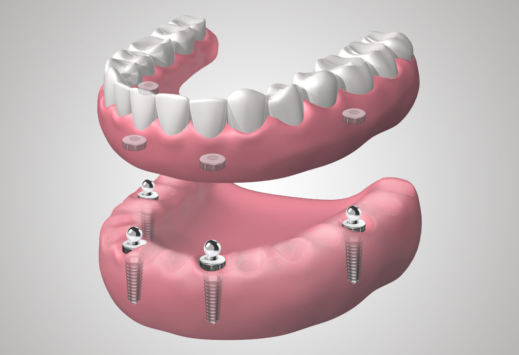 implantes dentales en El Masnou (Maresme)