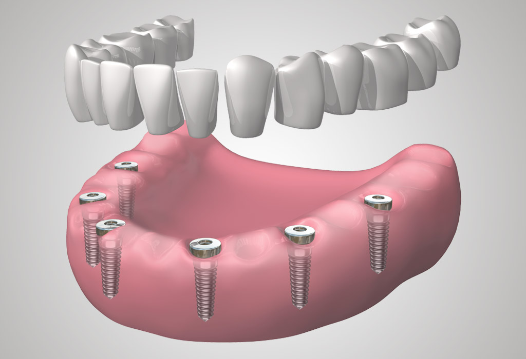 implantes dentales en El Masnou (Maresme)