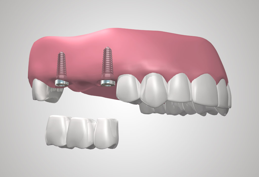 implantes dentales en El Masnou (Maresme)