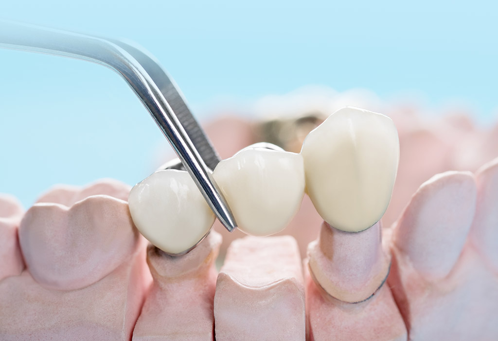 puente: prótesis dental fija en El Masnou